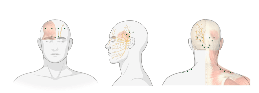 Botulinetoxine A (botox) bij migraine: hoe werkt het en wanneer wordt het vergoed?